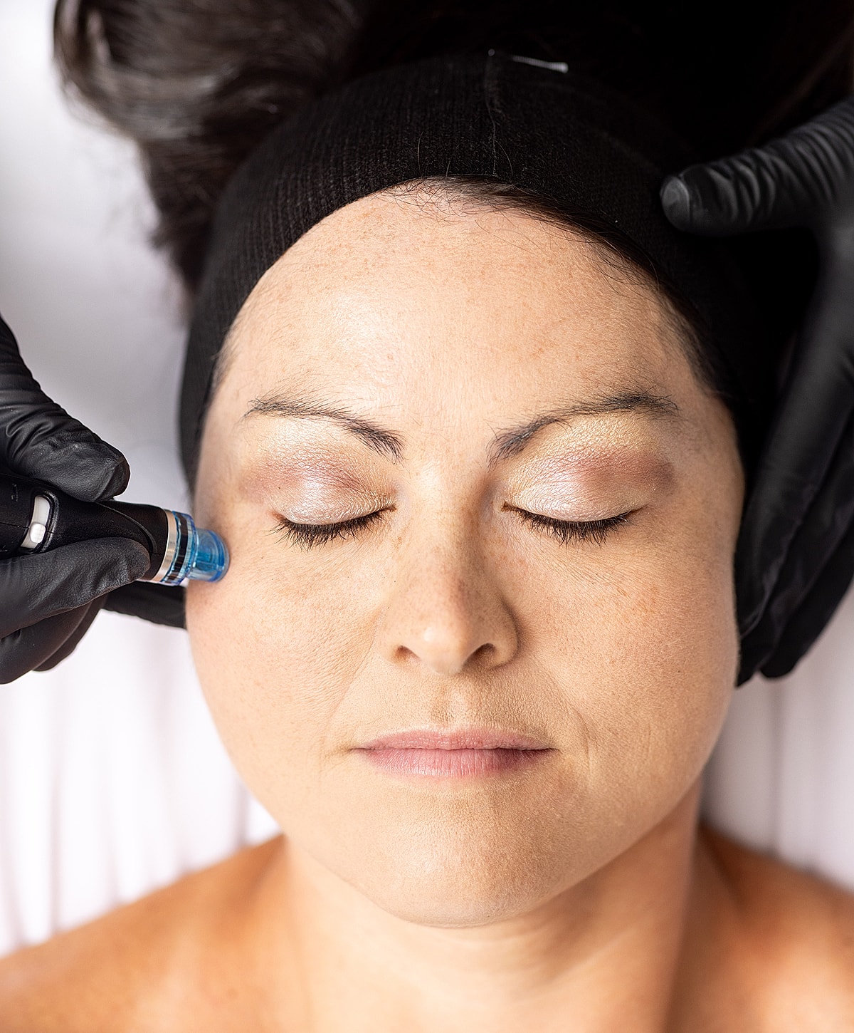 Facial treatment with microneedling procedure in progress.