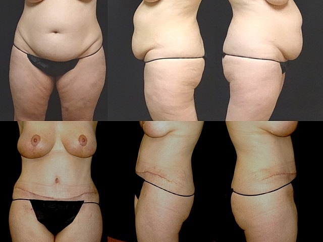 Mommy Makeover Before & After