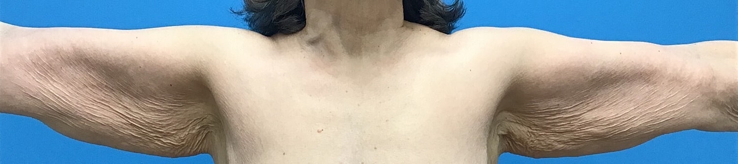 Brachioplasty Before & After