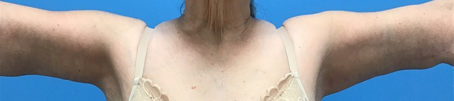 Brachioplasty Before & After
