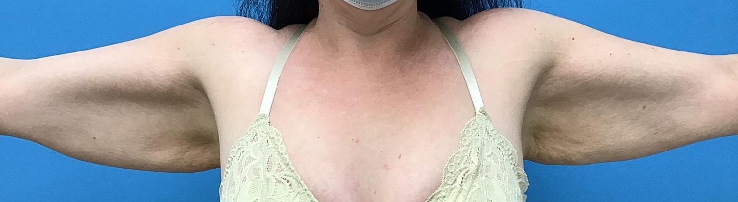 Brachioplasty Before & After