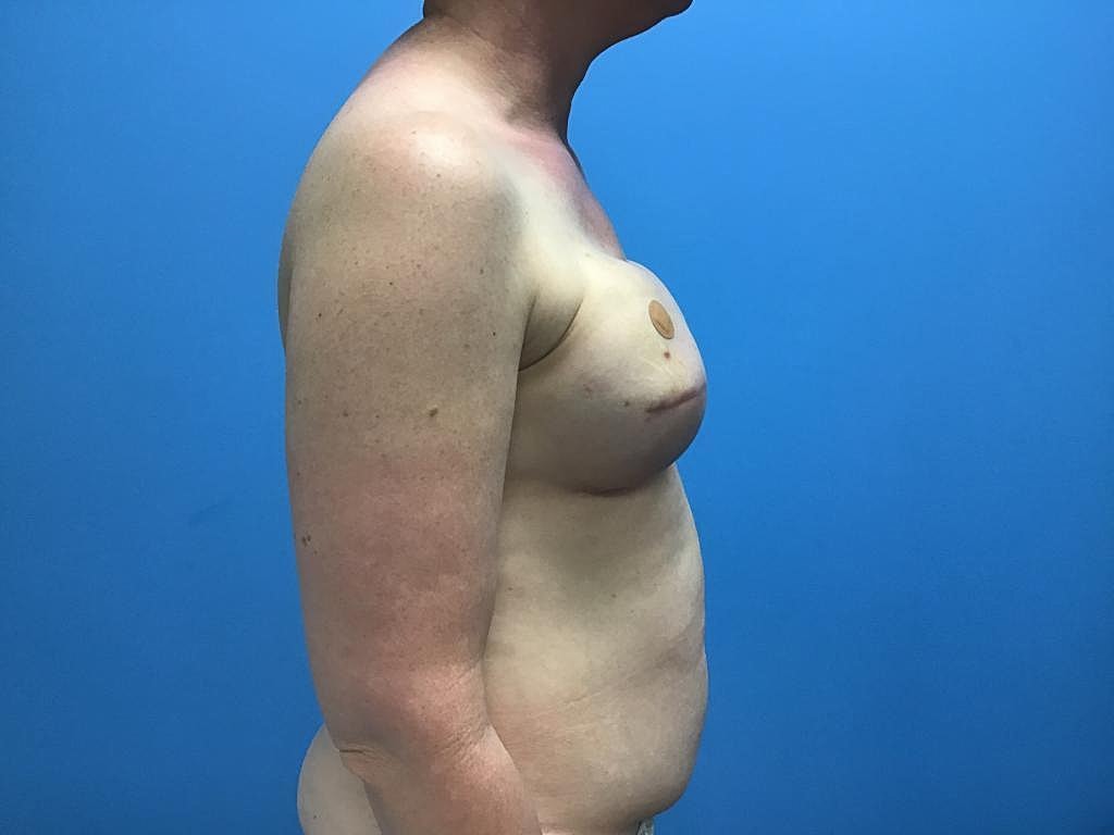 Breast Reconstruction Before & After