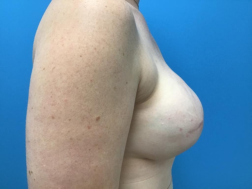 Breast Reconstruction Before & After