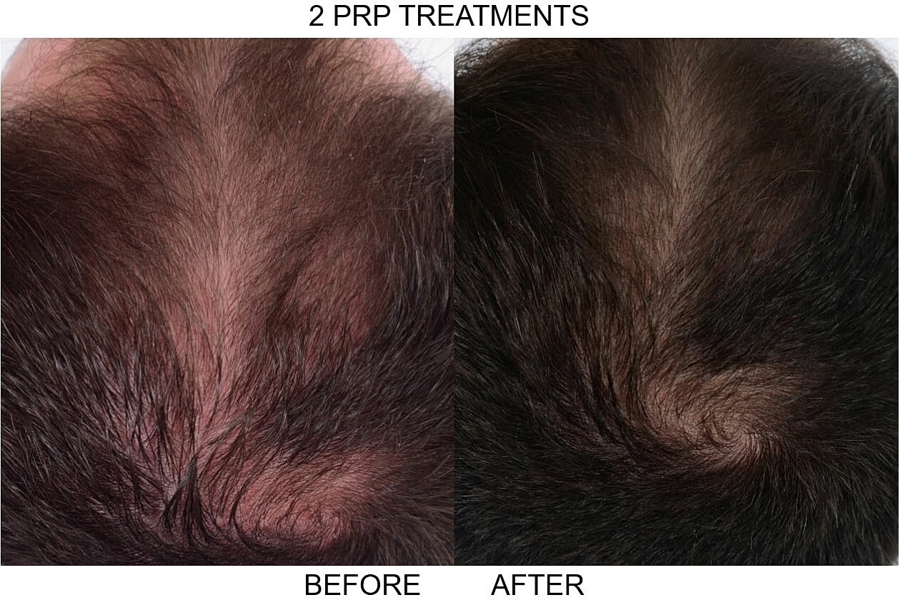 Prp Hair Loss Before & After