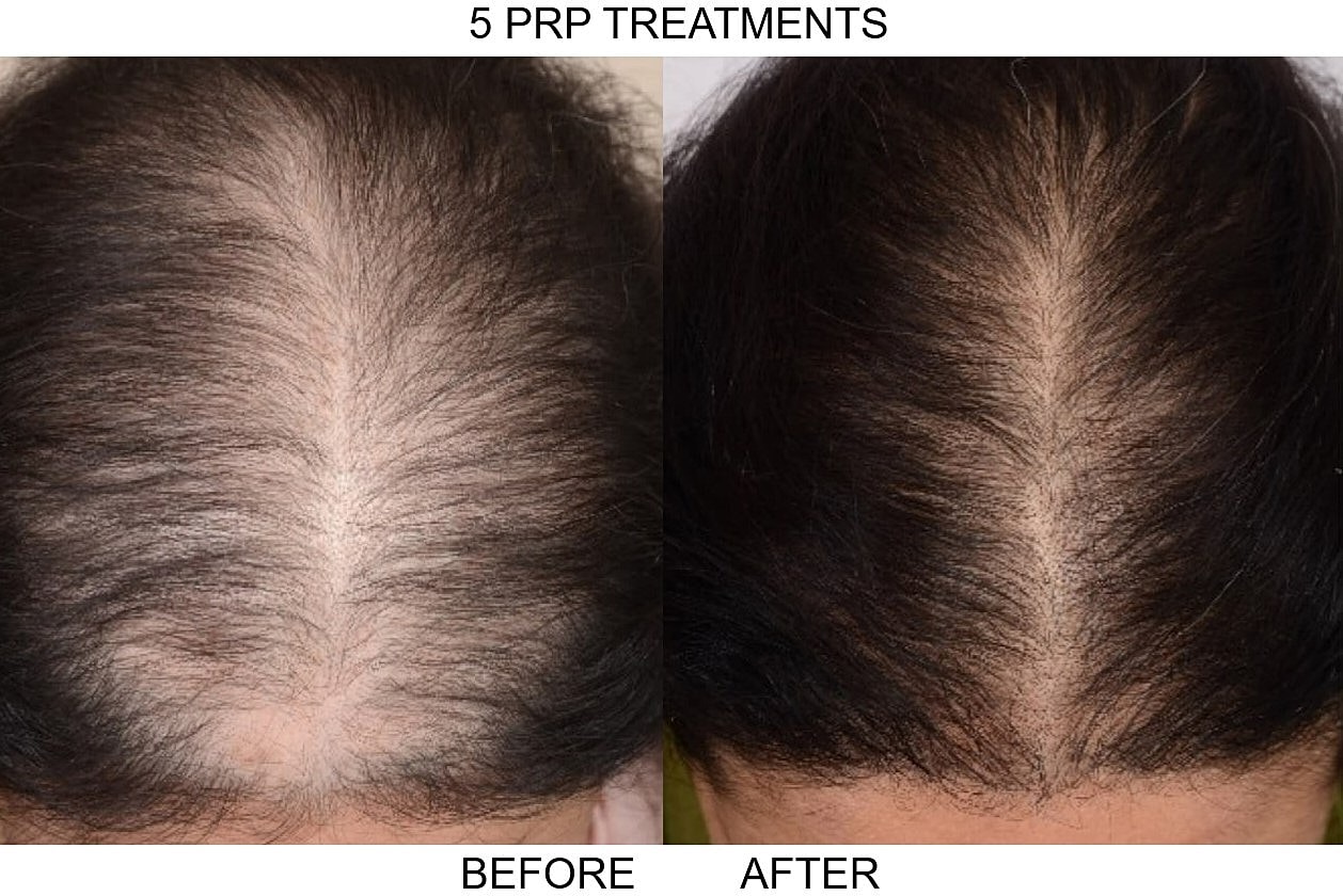 Prp Hair Loss Before & After