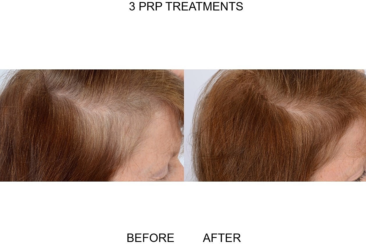 Prp Hair Loss Before & After