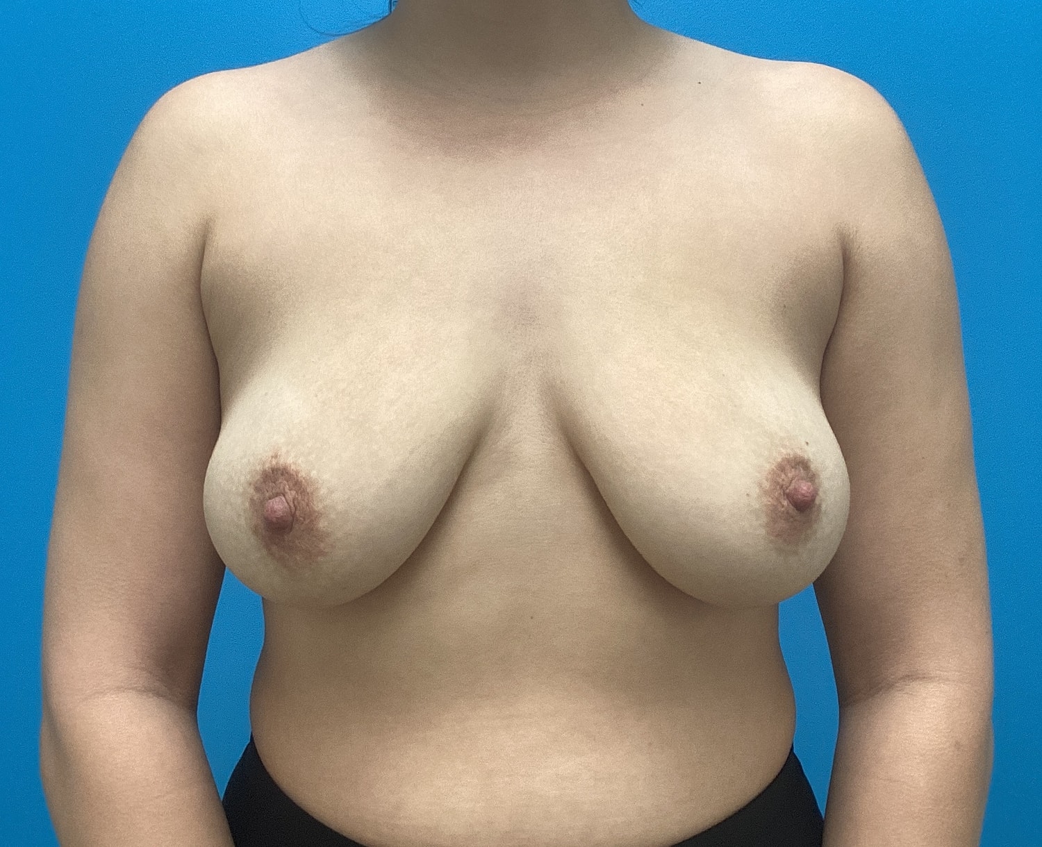 Breast Augmentation  Before & After