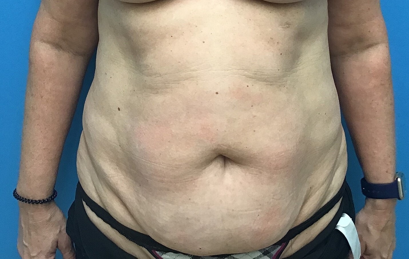 Abdominoplasty Before & After