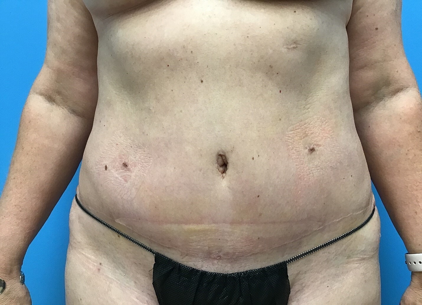 Abdominoplasty Before & After
