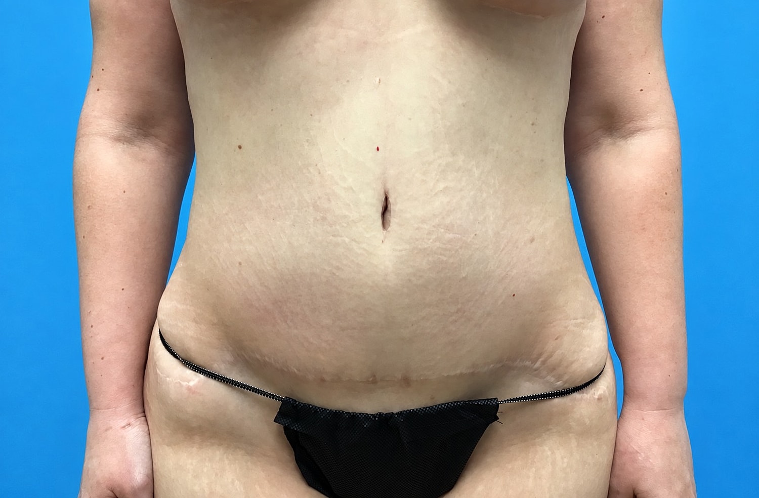 Abdominoplasty  Before & After