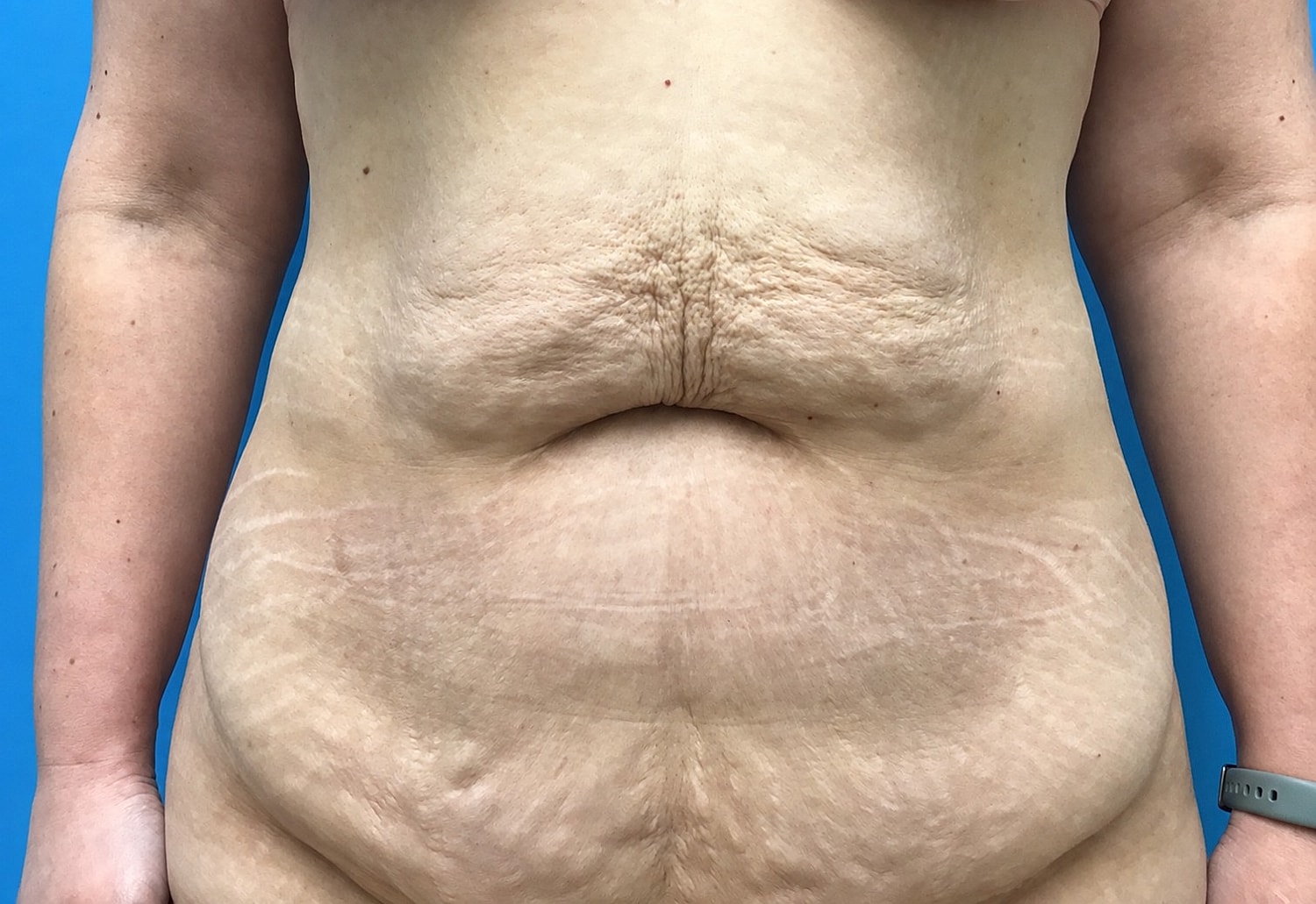 Abdominoplasty  Before & After