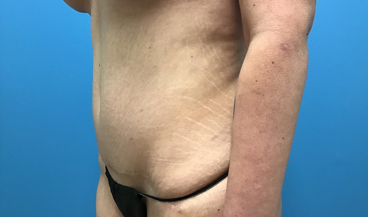 Abdominoplasty  Before & After