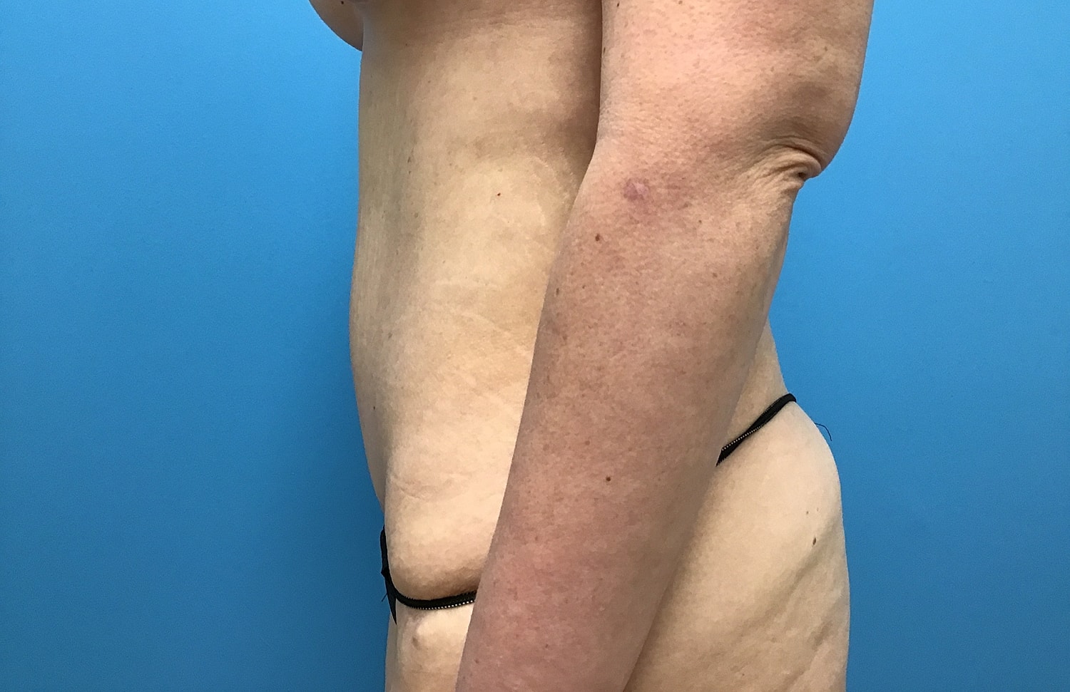 Abdominoplasty  Before & After