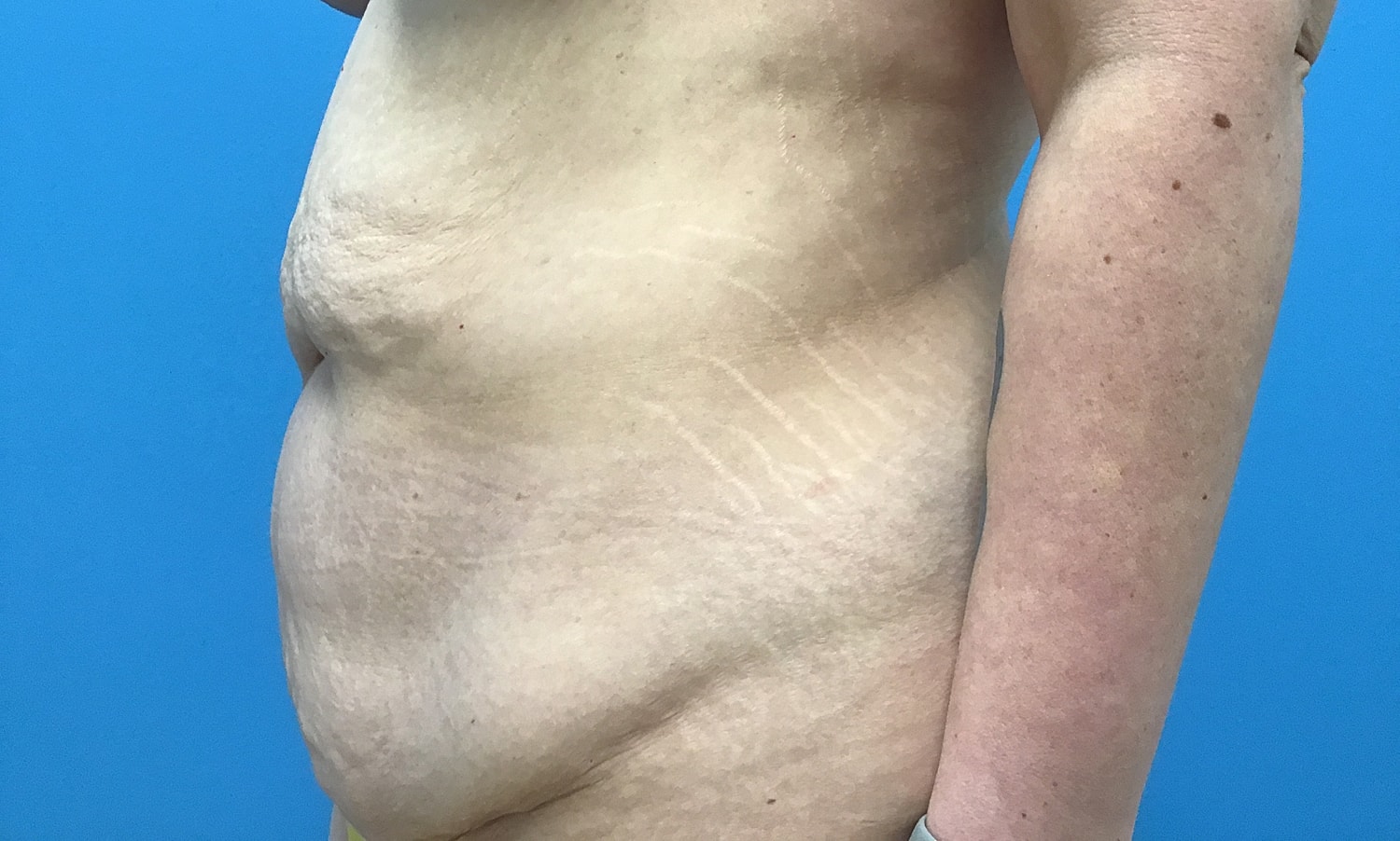 Abdominoplasty  Before & After