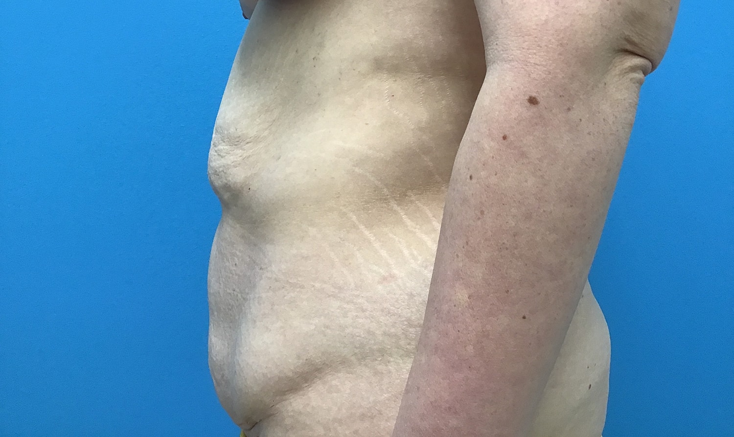 Abdominoplasty  Before & After
