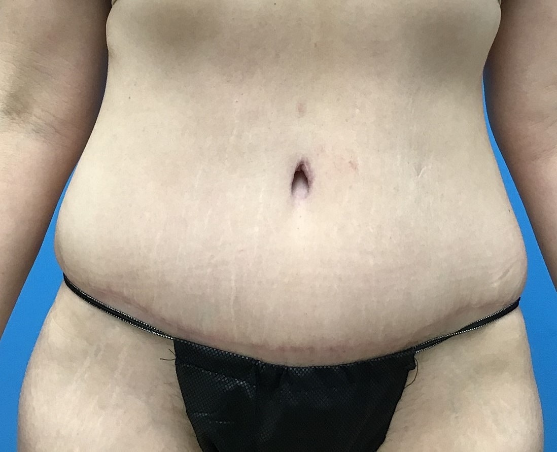 Abdominoplasty  Before & After