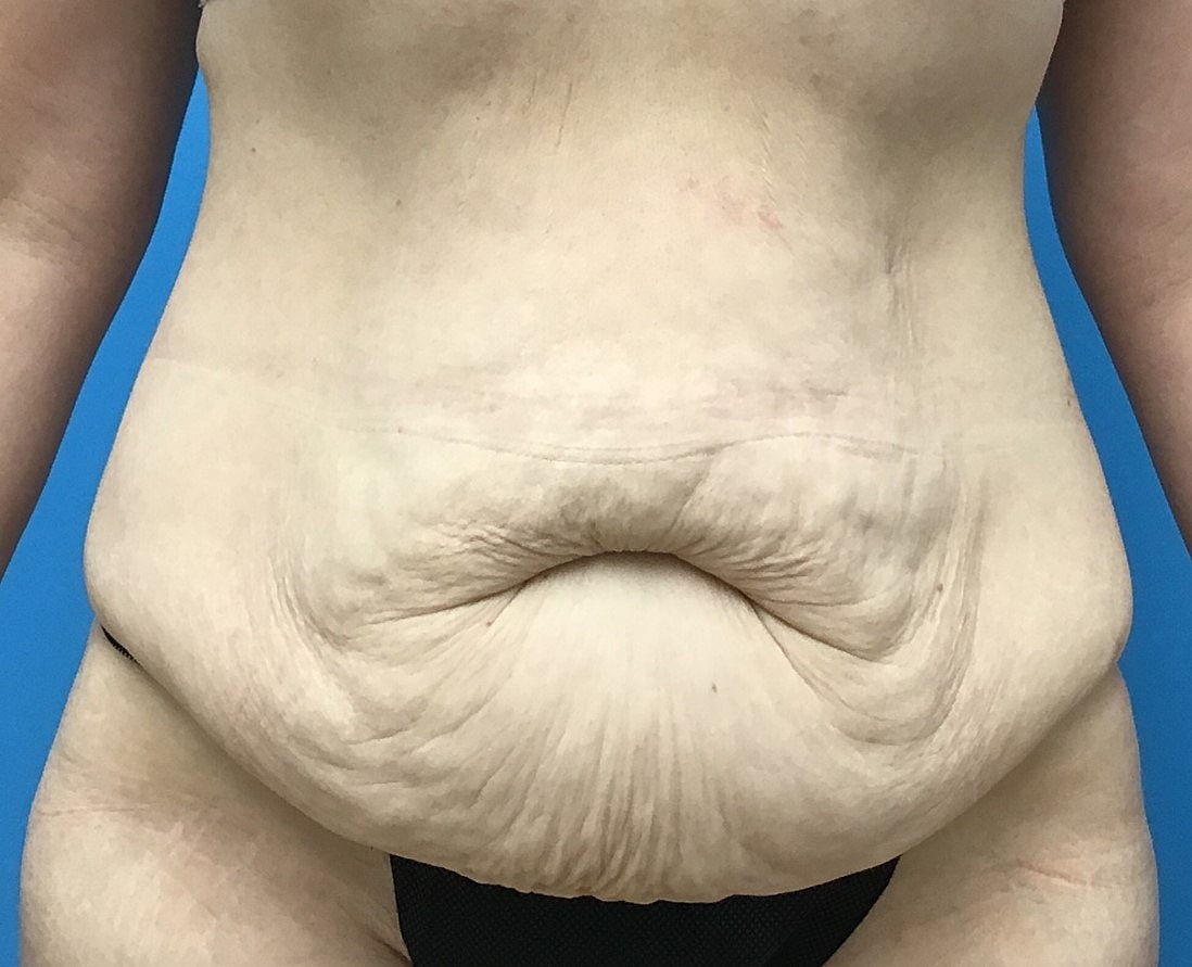 Abdominoplasty  Before & After