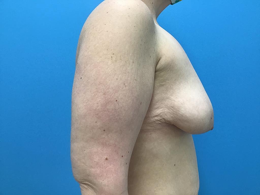 Breast Lift Before & After