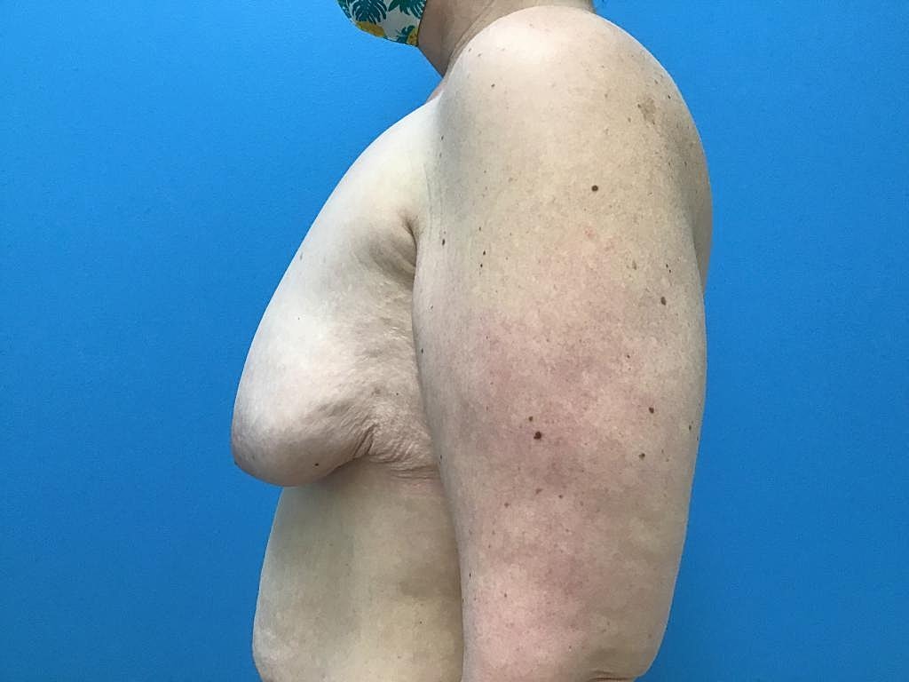 Breast Lift Before & After