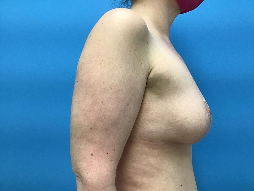 Breast Lift Before & After